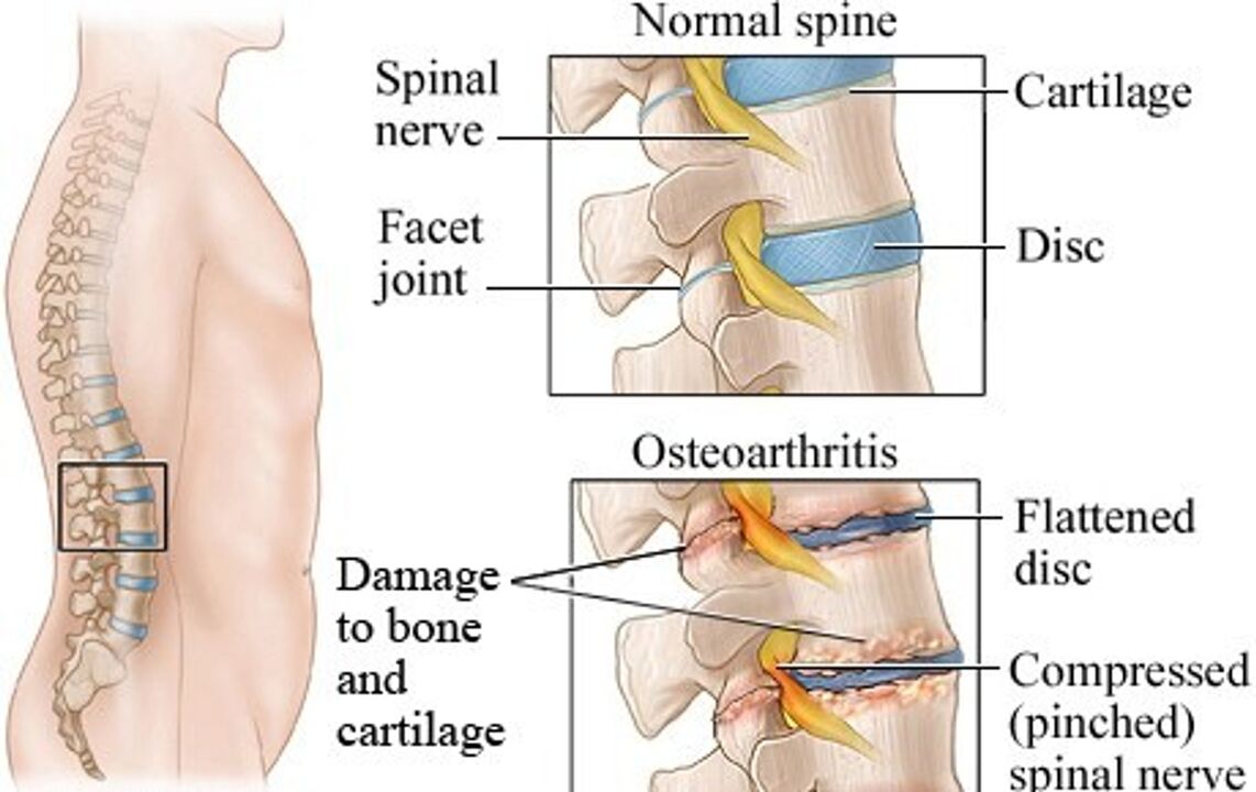 A diferença entre um disco saudável e um disco com osteocondrose