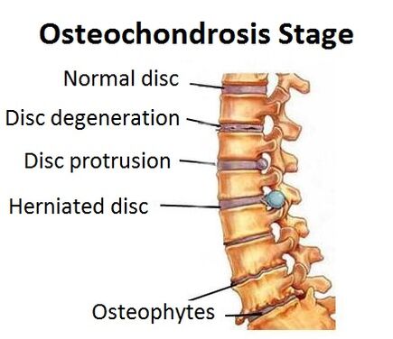 Estágios de osteocondrose