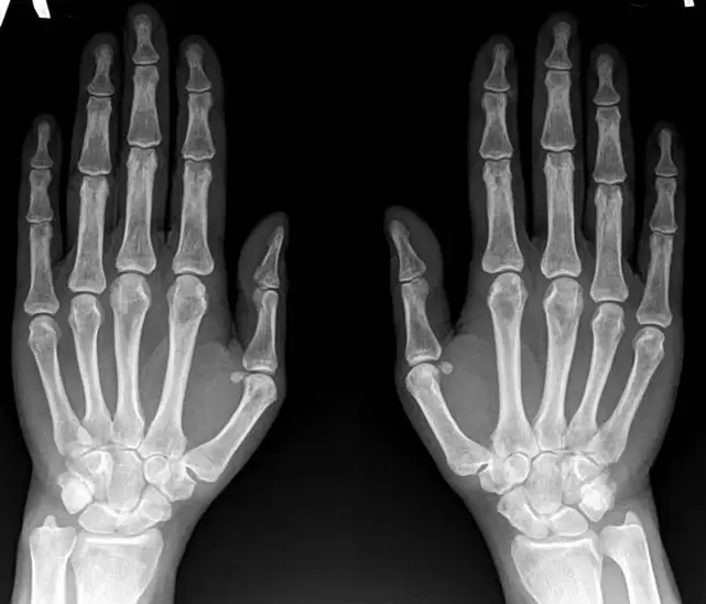 artrite da articulação do punho na radiografia antes de usar Hondroine